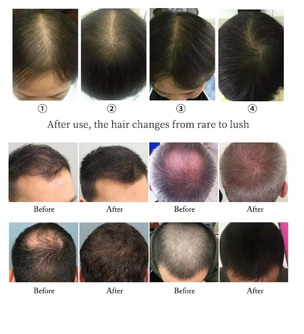 hair growth light cap1 hair growth light cap1