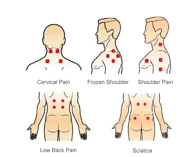 laser therapy for pain1 laser therapy for pain1
