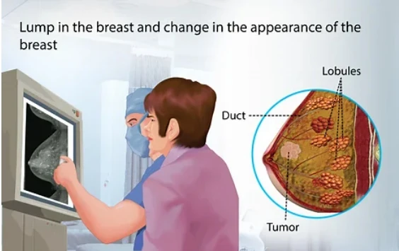 breast screening private1 breast screening private1