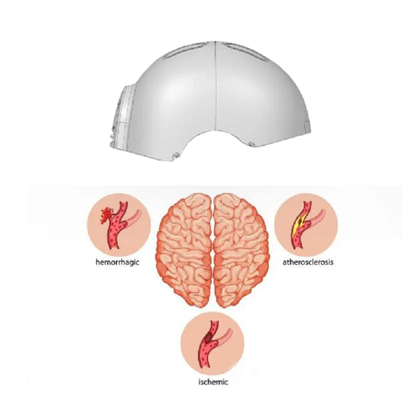 Red Light Therapy for Alzheimer's