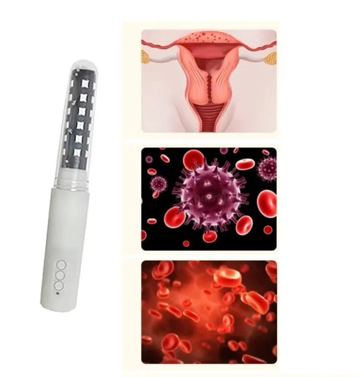 Laser Treatment for Vaginal Atrophy
